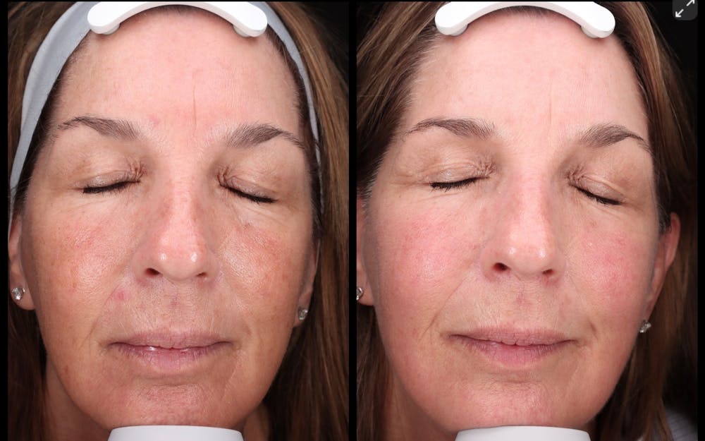 BBL Before & After Gallery - Patient 206787 - Image 2