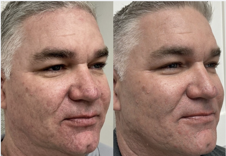VI Peel