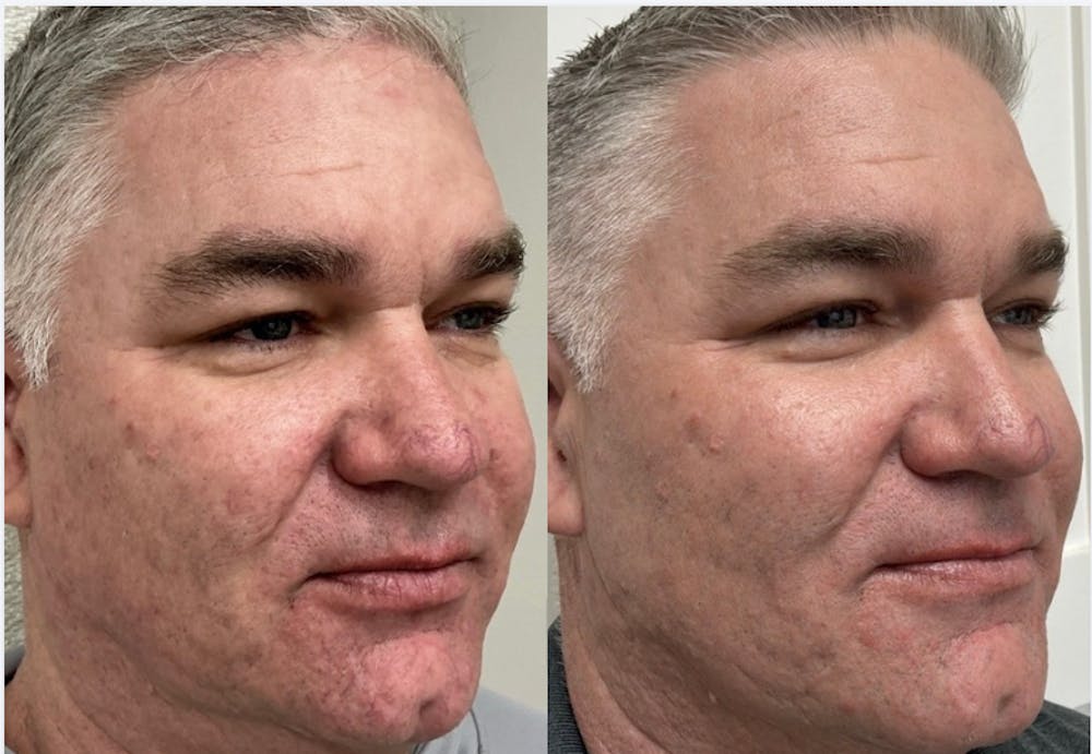 Dermal Fillers Before & After Gallery - Patient 171067 - Image 1