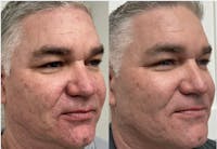 Dermal Fillers Before & After Gallery - Patient 171067 - Image 1