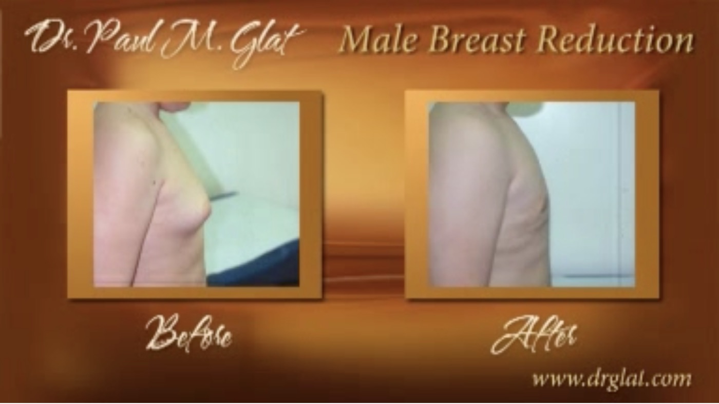 Male Breast Reduction Before and After