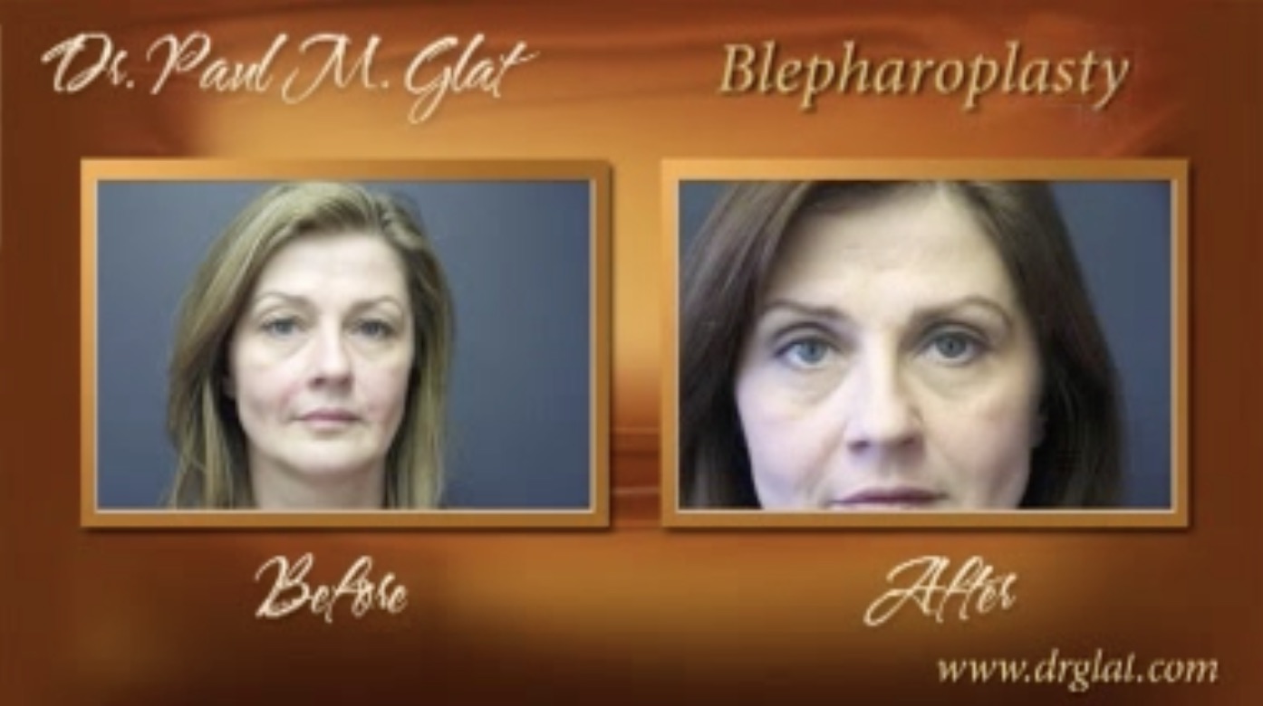 Blepharoplasty Before and After Photo