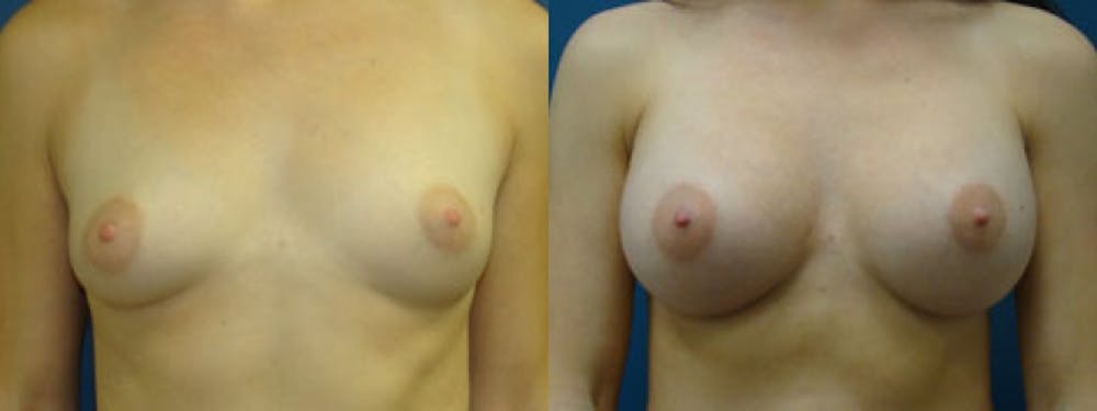 Breast Augmentation Before & After Gallery - Patient 5681434 - Image 1