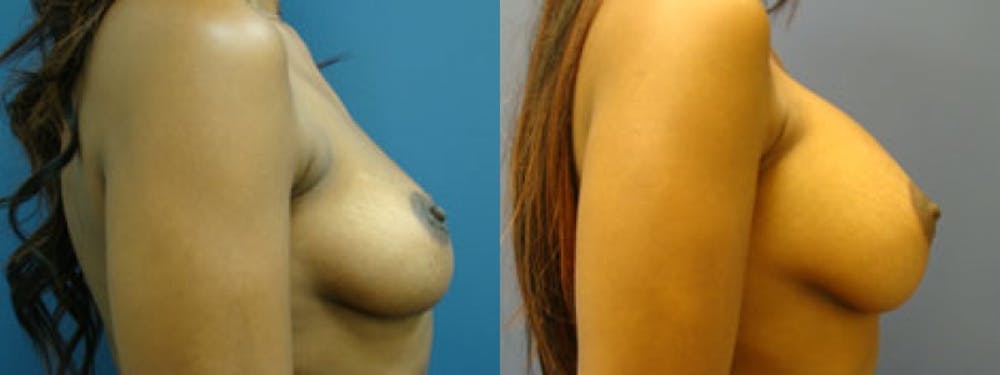 Breast Augmentation Before & After Gallery - Patient 5681436 - Image 1