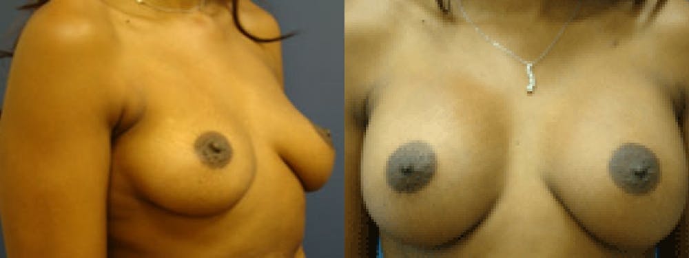 Breast Augmentation Before & After Gallery - Patient 5681437 - Image 1