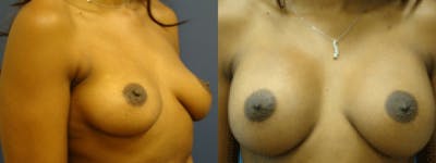 Breast Augmentation Before & After Gallery - Patient 5681437 - Image 1