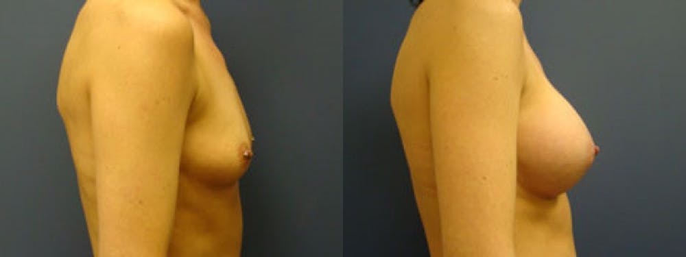 Breast Augmentation Before & After Gallery - Patient 5681438 - Image 1