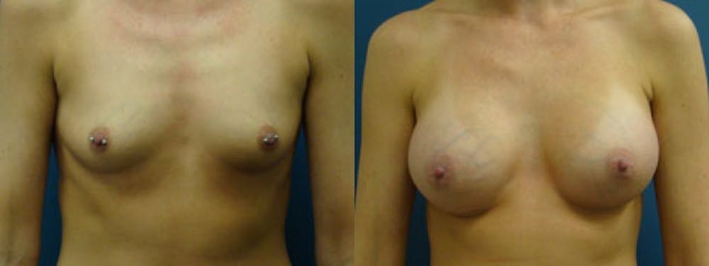 Breast Augmentation Before & After Gallery - Patient 5681439 - Image 1