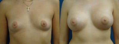 Breast Augmentation Before & After Gallery - Patient 5681440 - Image 1