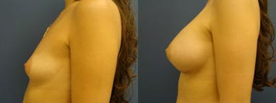 Breast Augmentation Before & After Gallery - Patient 5681441 - Image 1