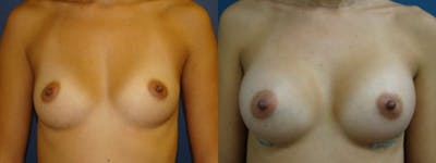 Breast Augmentation Before & After Gallery - Patient 5681442 - Image 1