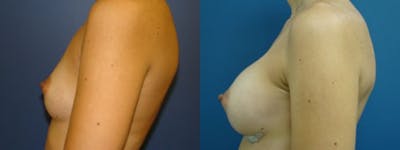 Breast Augmentation Before & After Gallery - Patient 5681443 - Image 1