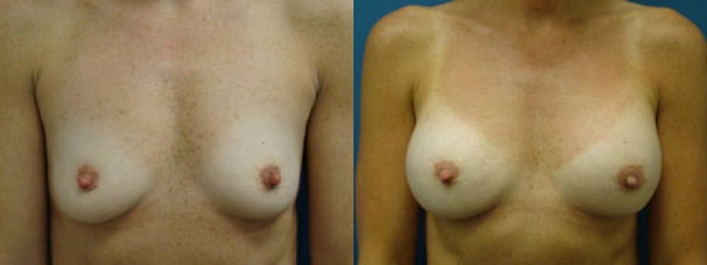 Breast Augmentation Before & After Gallery - Patient 5681444 - Image 1