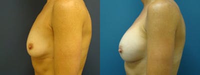 Breast Augmentation Before & After Gallery - Patient 5681445 - Image 1