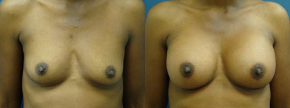 Breast Augmentation Before & After Gallery - Patient 5681446 - Image 1