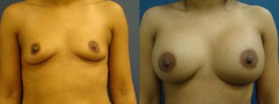 Breast Augmentation Before & After Gallery - Patient 5681447 - Image 1