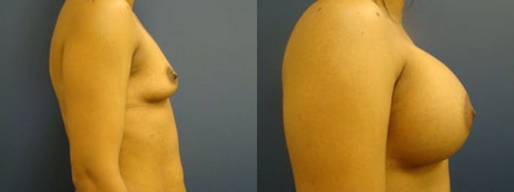 Breast Augmentation Before & After Gallery - Patient 5681448 - Image 1