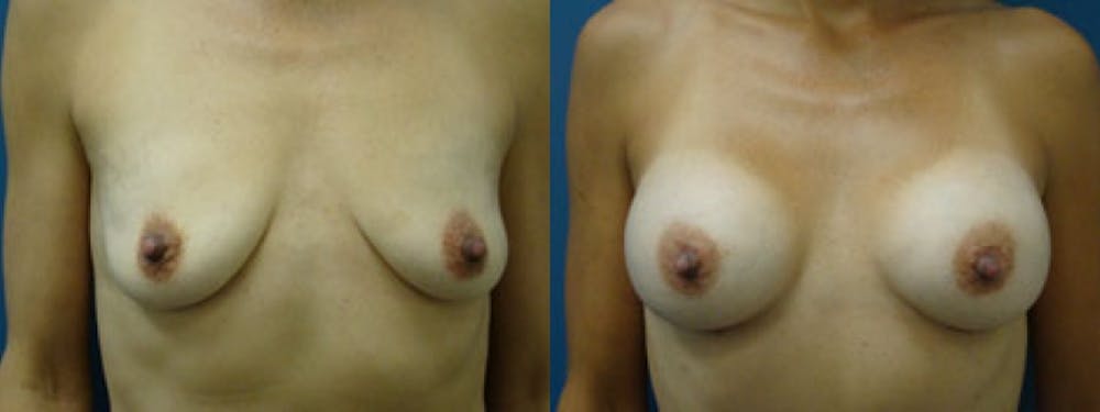 Breast Augmentation Before & After Gallery - Patient 5681449 - Image 1