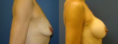 Breast Augmentation Before & After Gallery - Patient 5681450 - Image 1