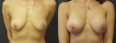 Breast Augmentation Before & After Gallery - Patient 5681451 - Image 1