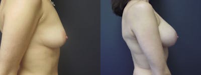 Breast Augmentation Before & After Gallery - Patient 5681452 - Image 1