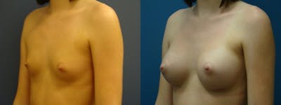 Breast Augmentation Before & After Gallery - Patient 5681453 - Image 1