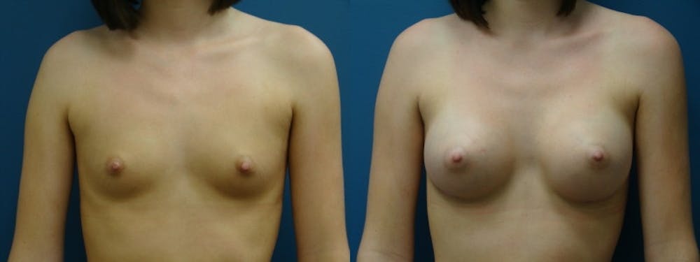 Breast Augmentation Before & After Gallery - Patient 5681454 - Image 1