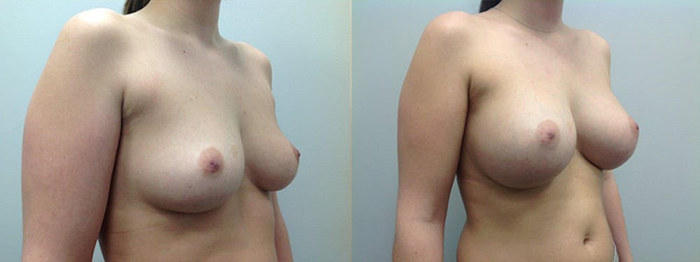Breast Augmentation Before & After Gallery - Patient 5681455 - Image 1