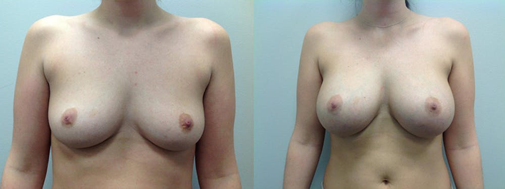 Breast Augmentation Before & After Gallery - Patient 5681456 - Image 1