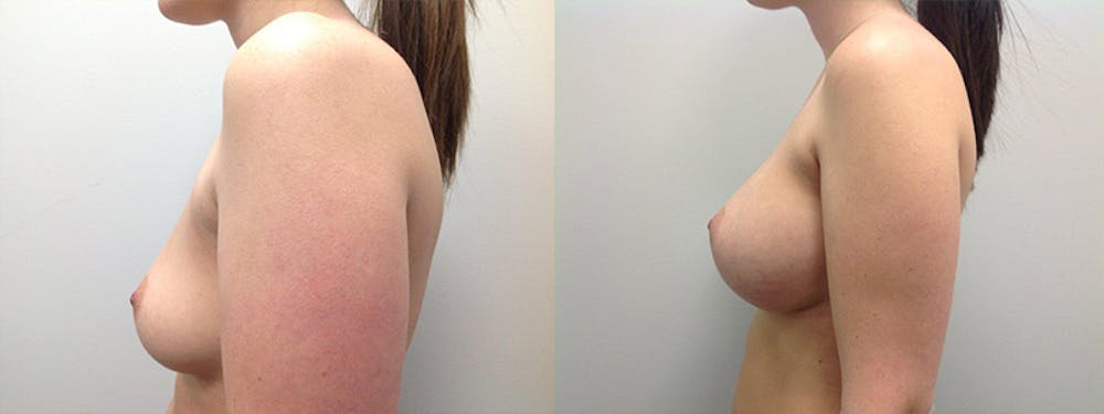 Breast Augmentation Before & After Gallery - Patient 5681457 - Image 1