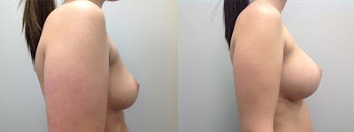 Breast Augmentation Before & After Gallery - Patient 5681458 - Image 1