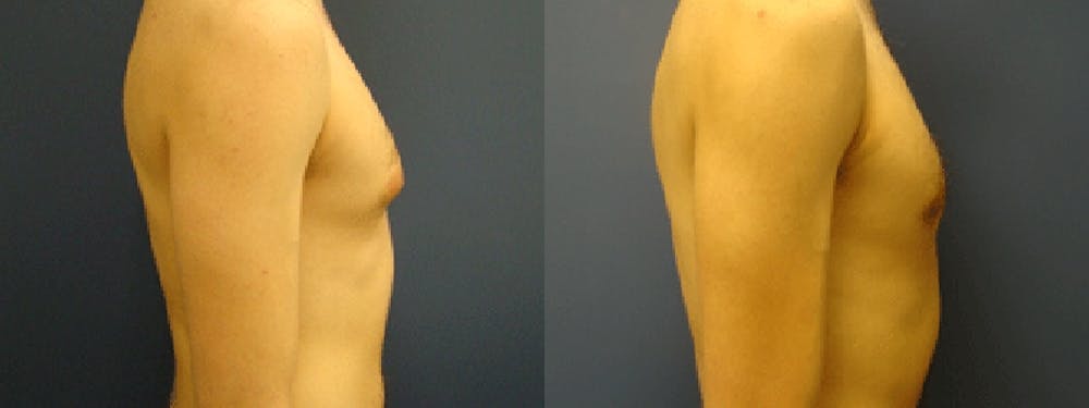 Gynecomastia/Male Breast Reduction Before & After Gallery - Patient 5681459 - Image 1