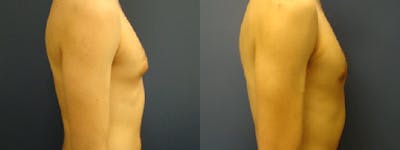 Gynecomastia/Male Breast Reduction Before & After Gallery - Patient 5681459 - Image 1