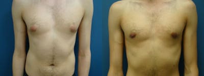 Gynecomastia/Male Breast Reduction Before & After Gallery - Patient 5681460 - Image 1