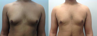 Gynecomastia/Male Breast Reduction Before & After Gallery - Patient 5681461 - Image 1
