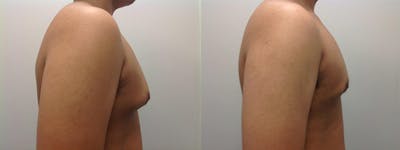 Gynecomastia/Male Breast Reduction Before & After Gallery - Patient 5681462 - Image 1