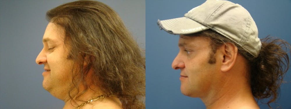 Liposuction Before & After Gallery - Patient 5681467 - Image 2