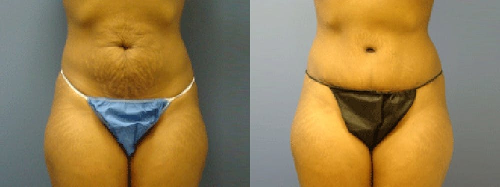 Before & After Liposuction in Pittsburgh