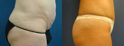 Liposuction Gallery - Patient 5681469 - Image 1