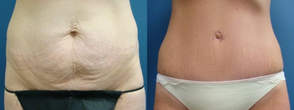 Tummy Tuck