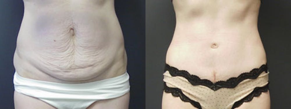 Before & After Liposuction in Pittsburgh