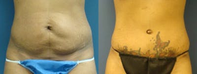 Liposuction Gallery - Patient 5681471 - Image 1