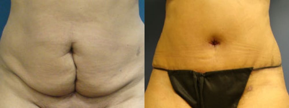 Tummy Tuck