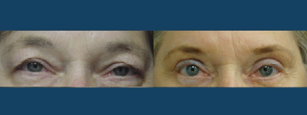 Eyelid Surgery Before & After Gallery - Patient 5681473 - Image 1