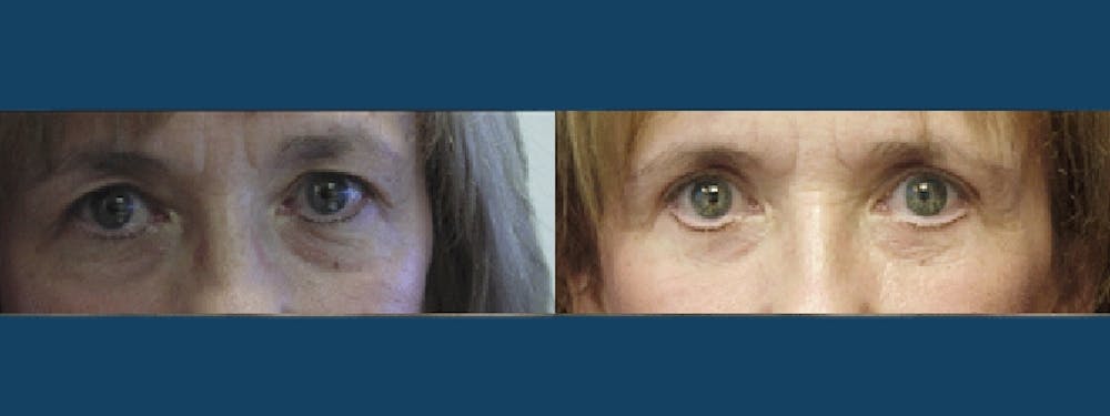 Eyelid Surgery Before & After Gallery - Patient 5681474 - Image 1