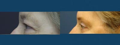 Eyelid Surgery Before & After Gallery - Patient 5681473 - Image 2
