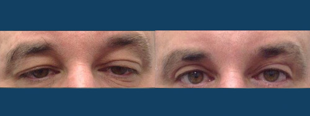 Eyelid Surgery Gallery - Patient 5681475 - Image 1