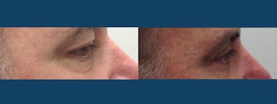 Eyelid Surgery Before & After Gallery - Patient 5681475 - Image 2