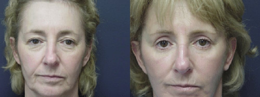Facelift Before & After Gallery - Patient 5681478 - Image 1