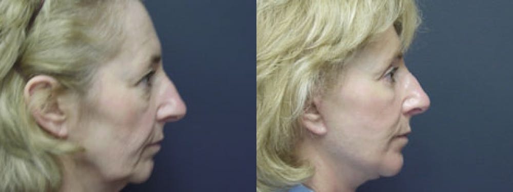 Facelift Before & After Gallery - Patient 5681478 - Image 2